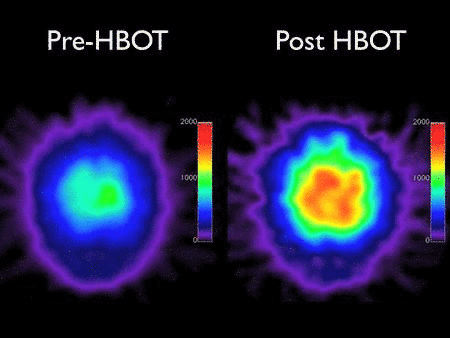 Pre HBOT | Post HBOT - Brain Blood Flow Scan
